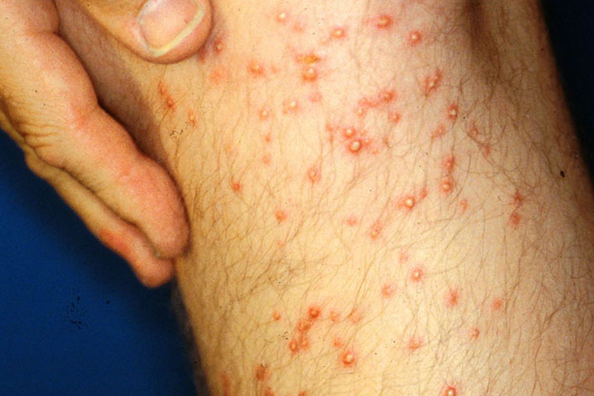 Fire Ant Bites